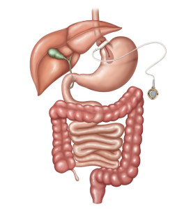 Ilustração de como fica o sistema digestivo com utilização da Banda Gástrica Ajustável, um tipo de cirurgia bariátrica