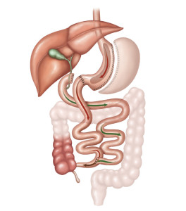 Ilustração de um sistema digestivo após Derivação Bilio-pancreática, um tipo de cirurgia bariátrica
