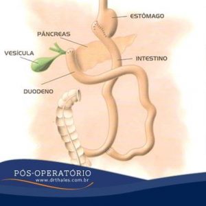 Estenose da Gastro entero anastomose