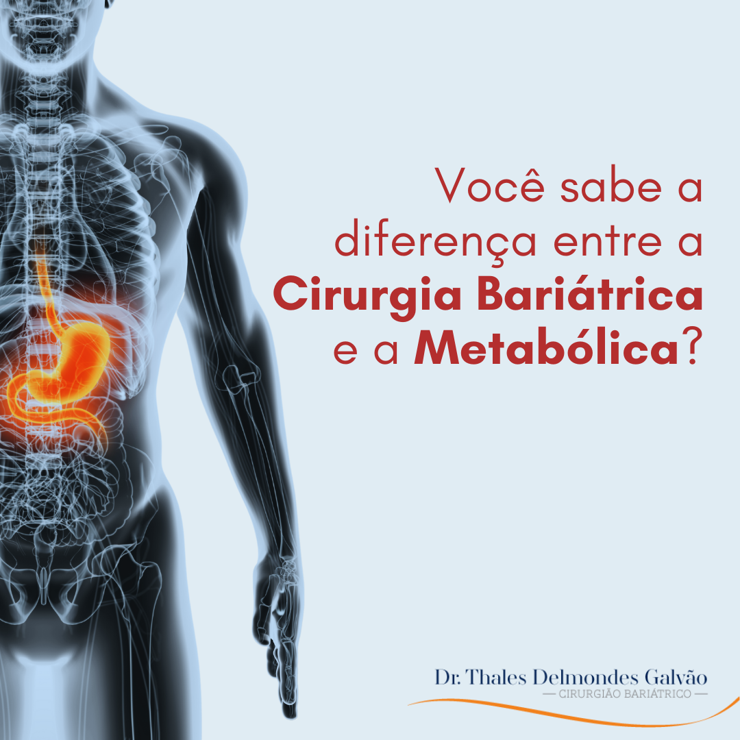 Diferença Entre Cirurgia Bariátrica E Metabólica Dr Thales Delmondes Galvão Cirurgia 3838